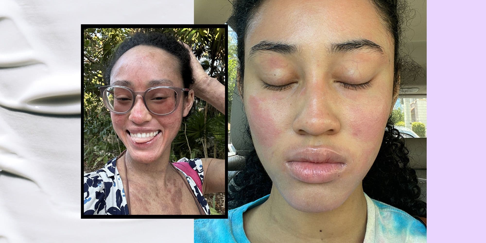What Is Topical Steroid Withdrawal Syndome—The Skin Condition Taking TikTok By Storm