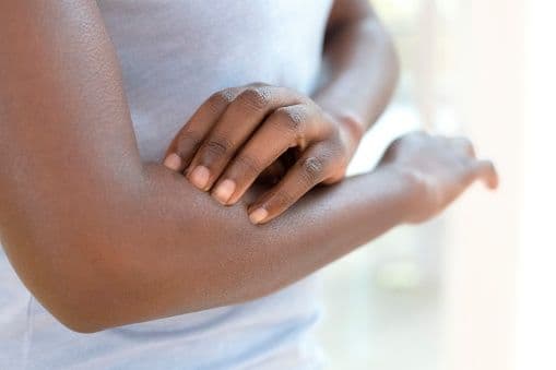Why Is Eczema More Prevalent in Black Skin?