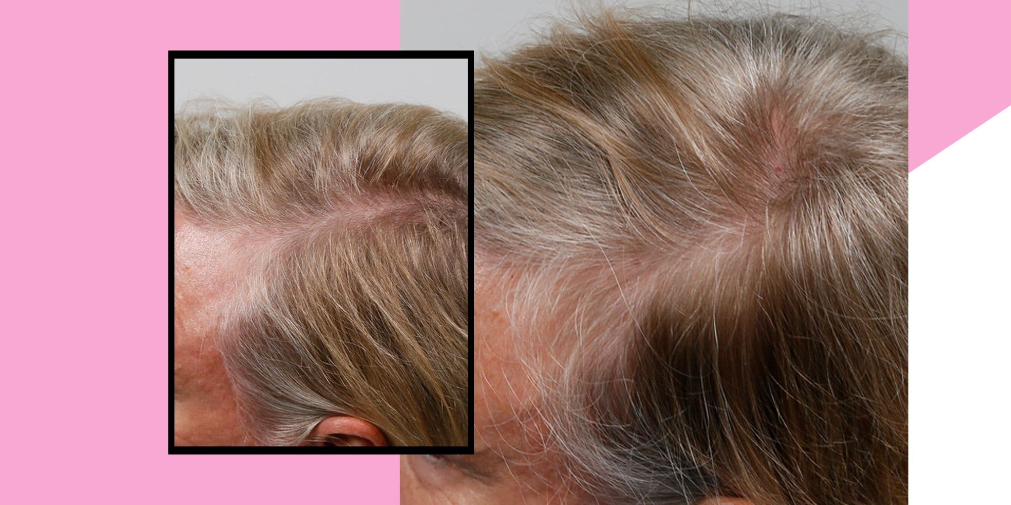 ‘This Laser Device Helped Regrow My Hair Post-Covid—When Nothing Else Would’