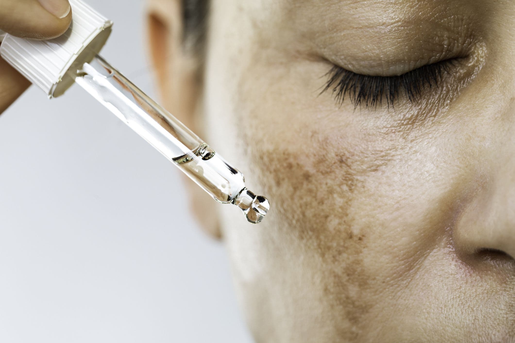 These Are The Best Ways To Treat Melasma, According To Dermatologists