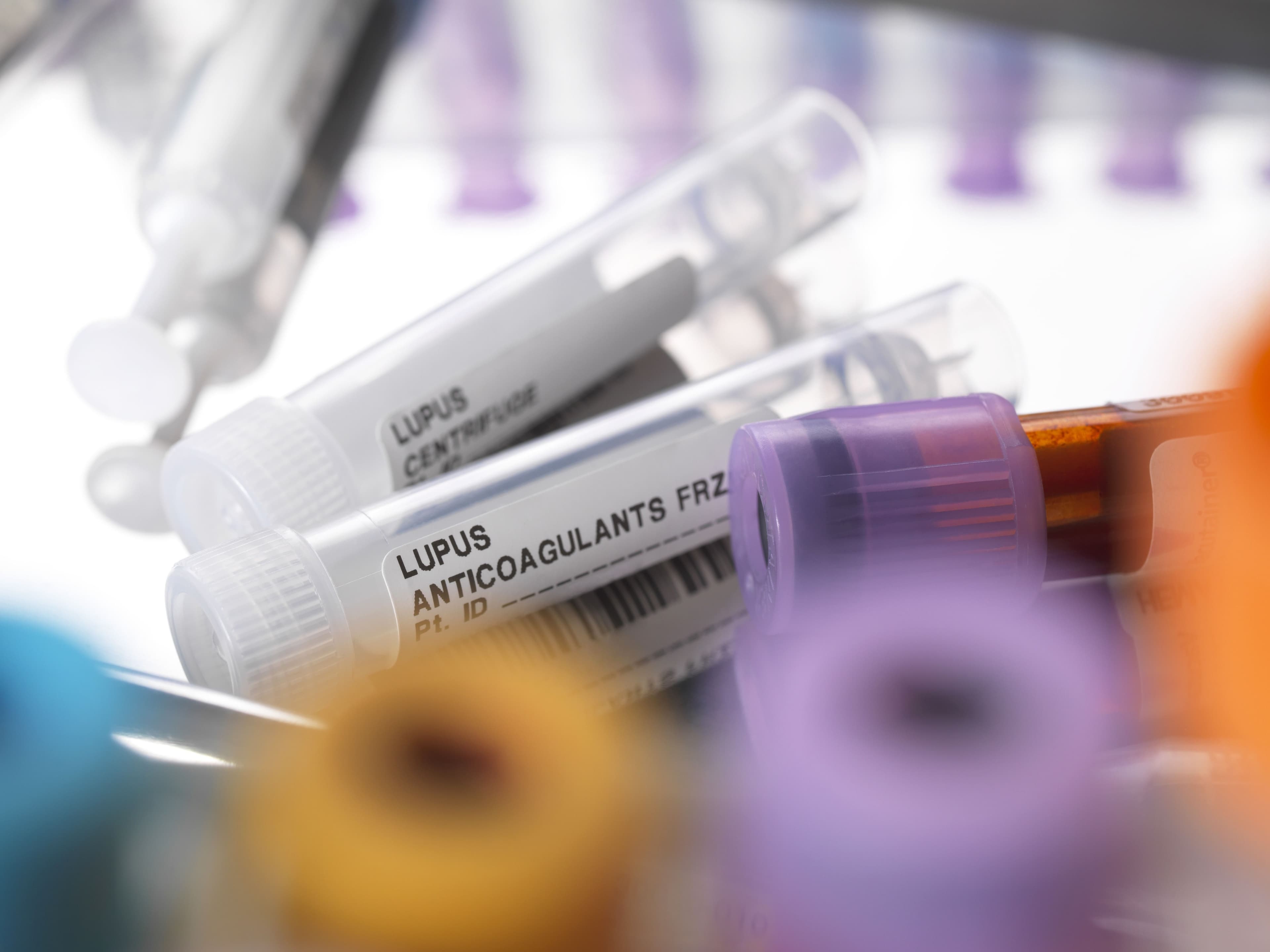 What Causes Lupus? A New Study Points To This Genetic Abnormality