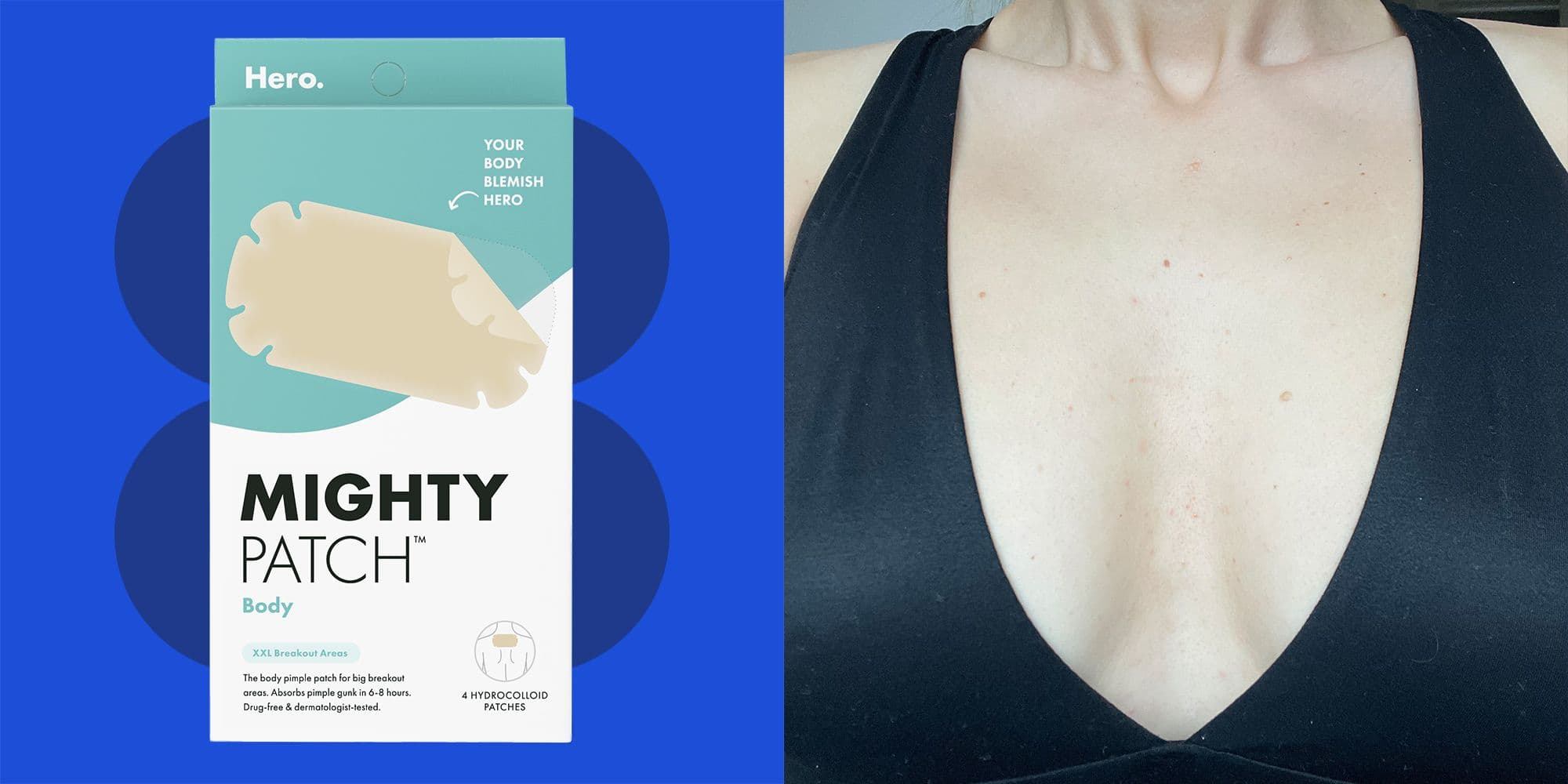 Hero Cosmetics Mighty Patch Body Review: My Honest Opinion After 3 Weeks Of Testing