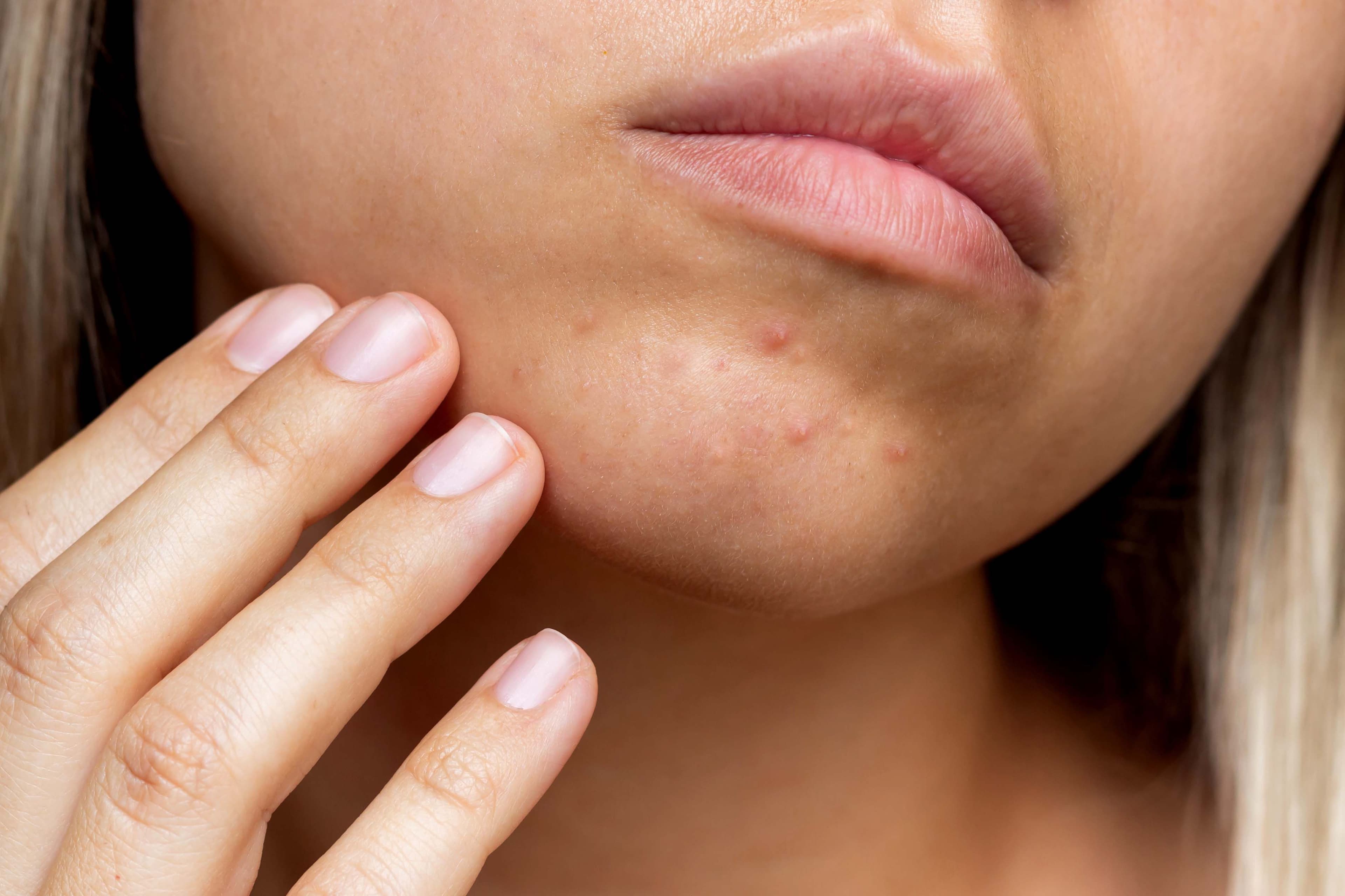Here’s How To Get Rid Of Chin Acne, According To Dermatologists